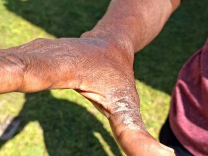 Michael’s hand shows the lingering effects of chemical overexposure, even after the worst of the flare-up has subsided.